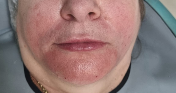 Depois do tratamento: Aplicação de Ácido Hialurônico no Sulco Nasolabial