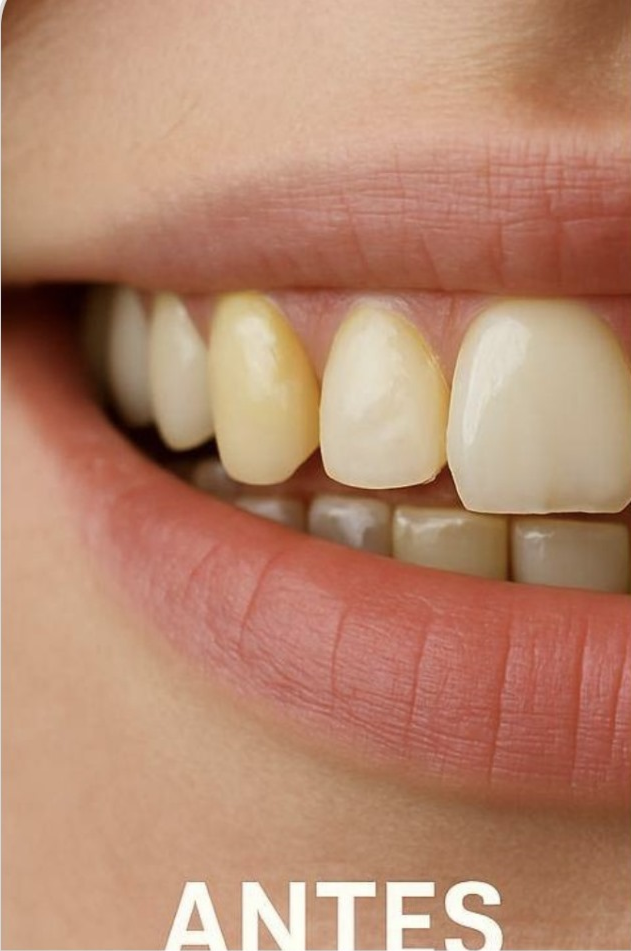 Antes do tratamento: Clareamento Dental