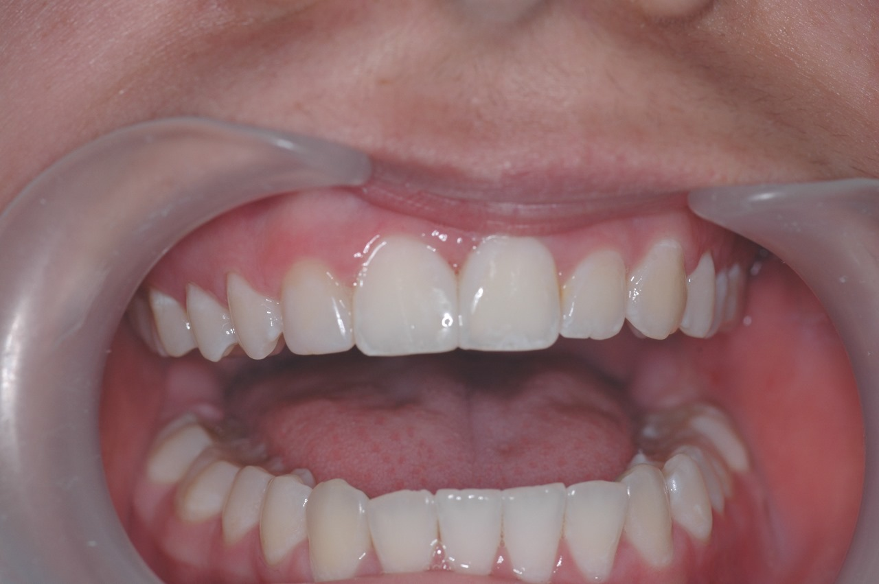 Depois do tratamento: Fechamento de Diastema