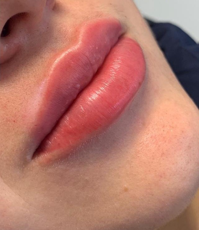 Depois do tratamento: Harmonização Facial