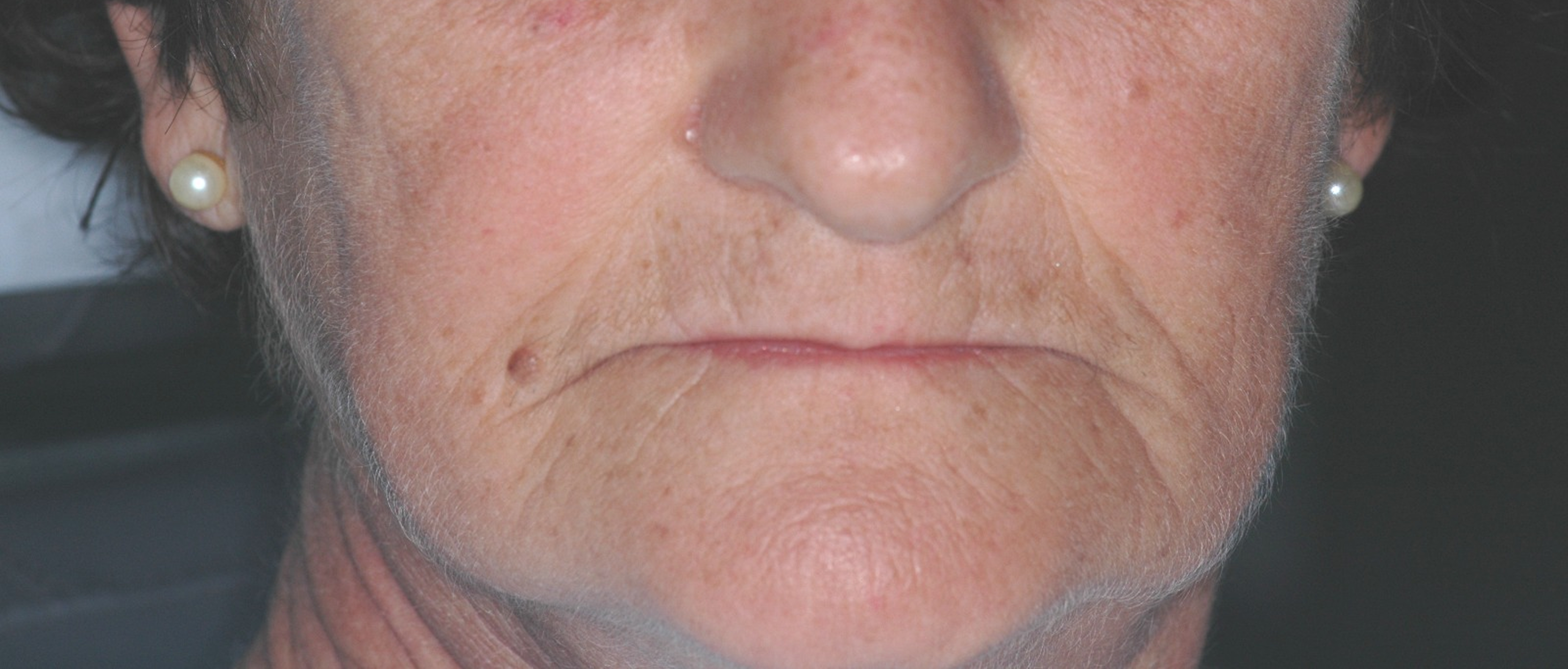 Antes do tratamento: Levantamento de Dimensão Vertical