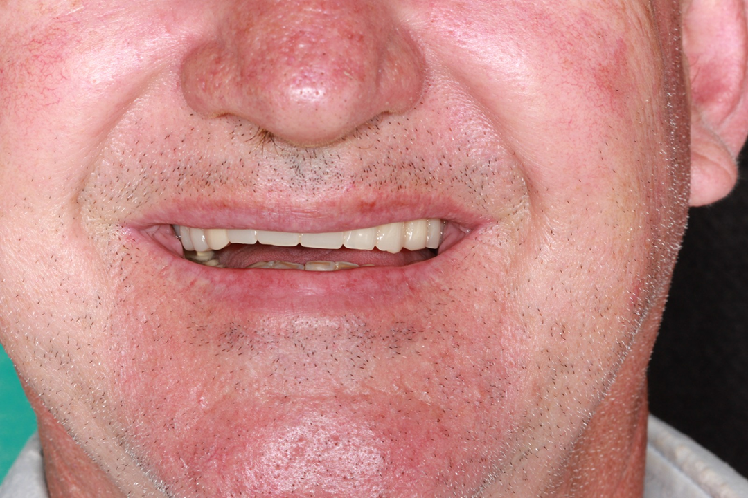 Antes do tratamento: Prótese Protocolo Sobre Implantes