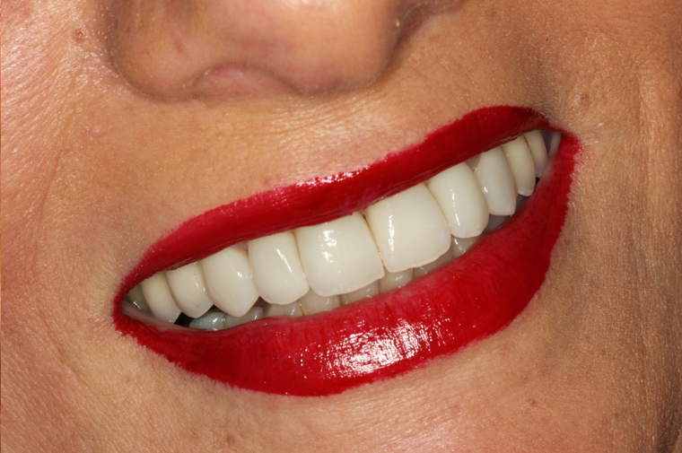 Depois do tratamento: Reabilitação Cerâmica 1