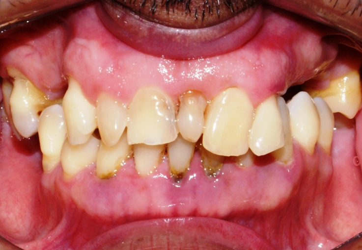 Antes do tratamento: Reabilitação Cerâmica 2