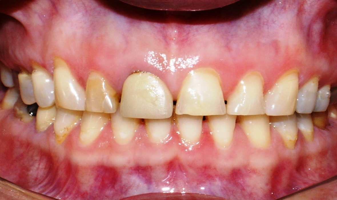 Antes do tratamento: Reabilitação Cerâmica