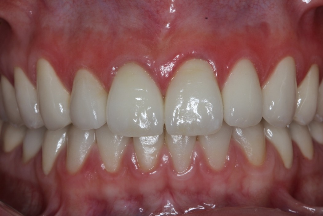 Depois do tratamento: Reabilitação Cerâmica