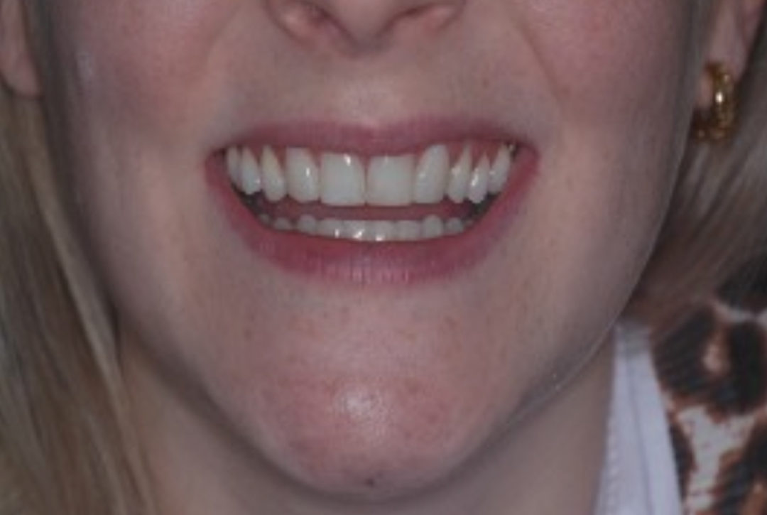 Antes do tratamento: Reabilitação com Facetas