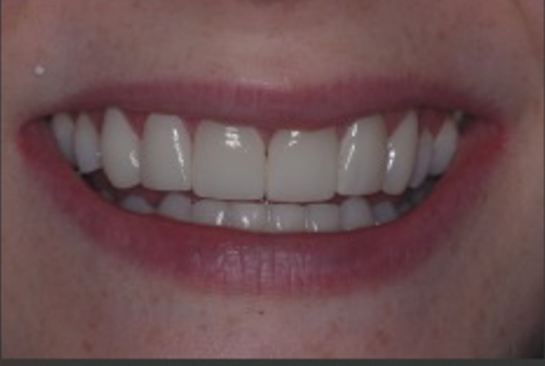 Depois do tratamento: Reabilitação com Facetas