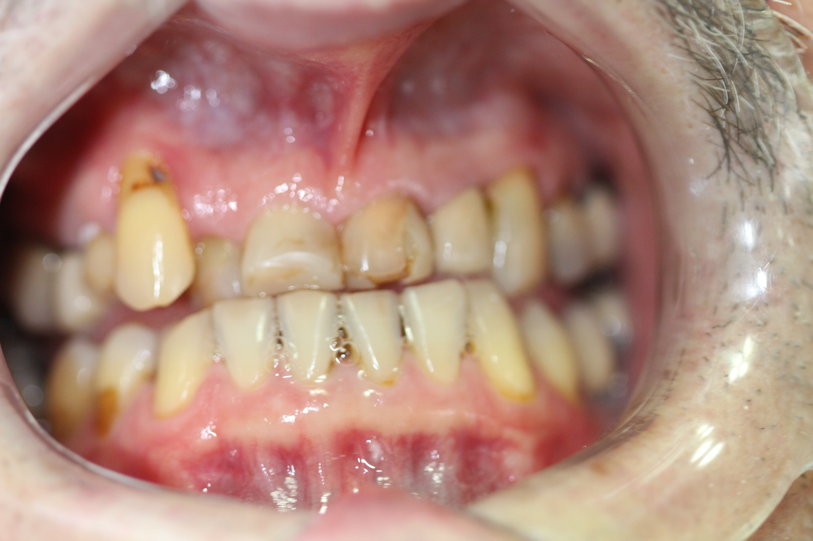 Antes do tratamento: Reabilitação com Implante