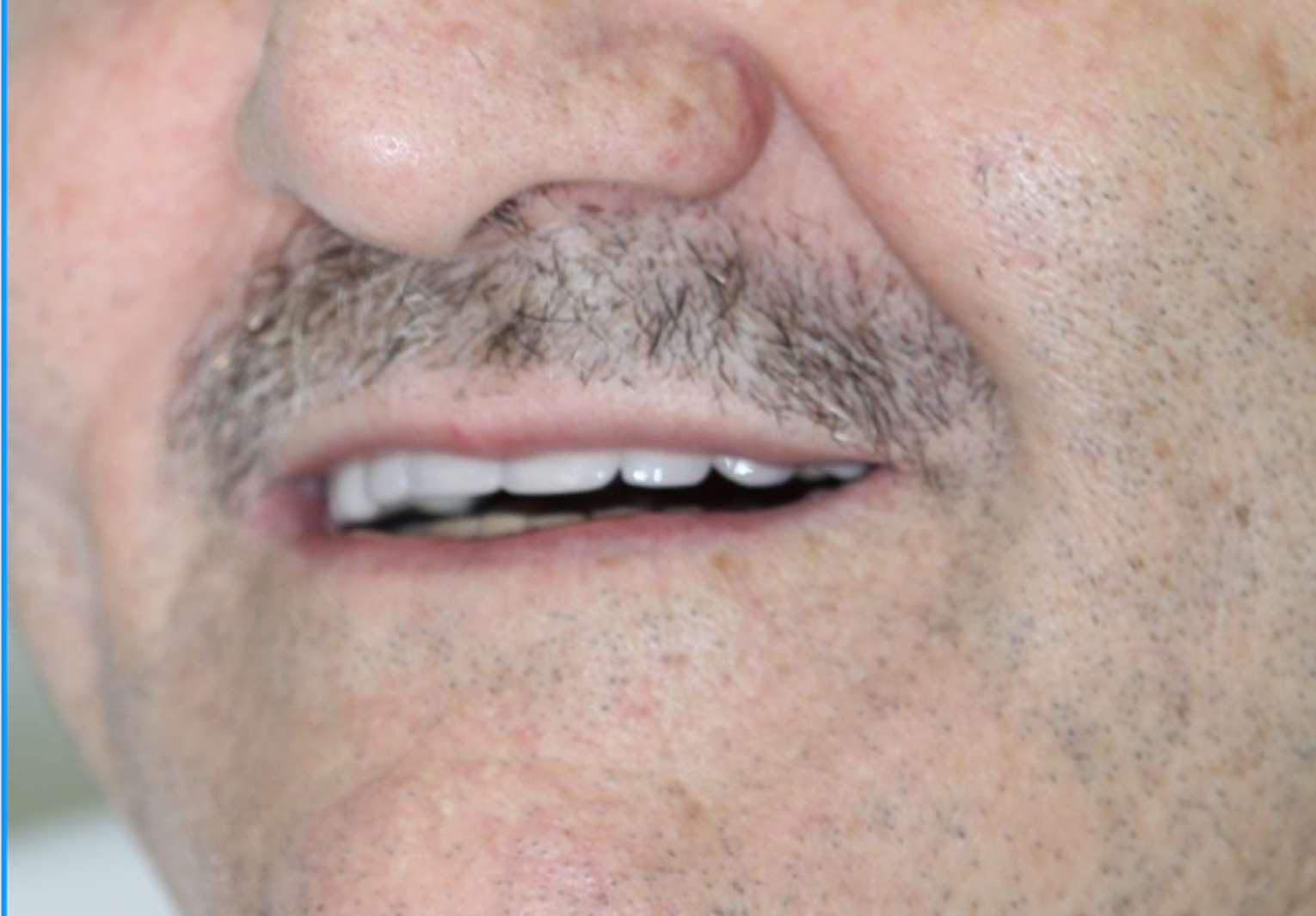 Depois do tratamento: Reabilitação com Implante