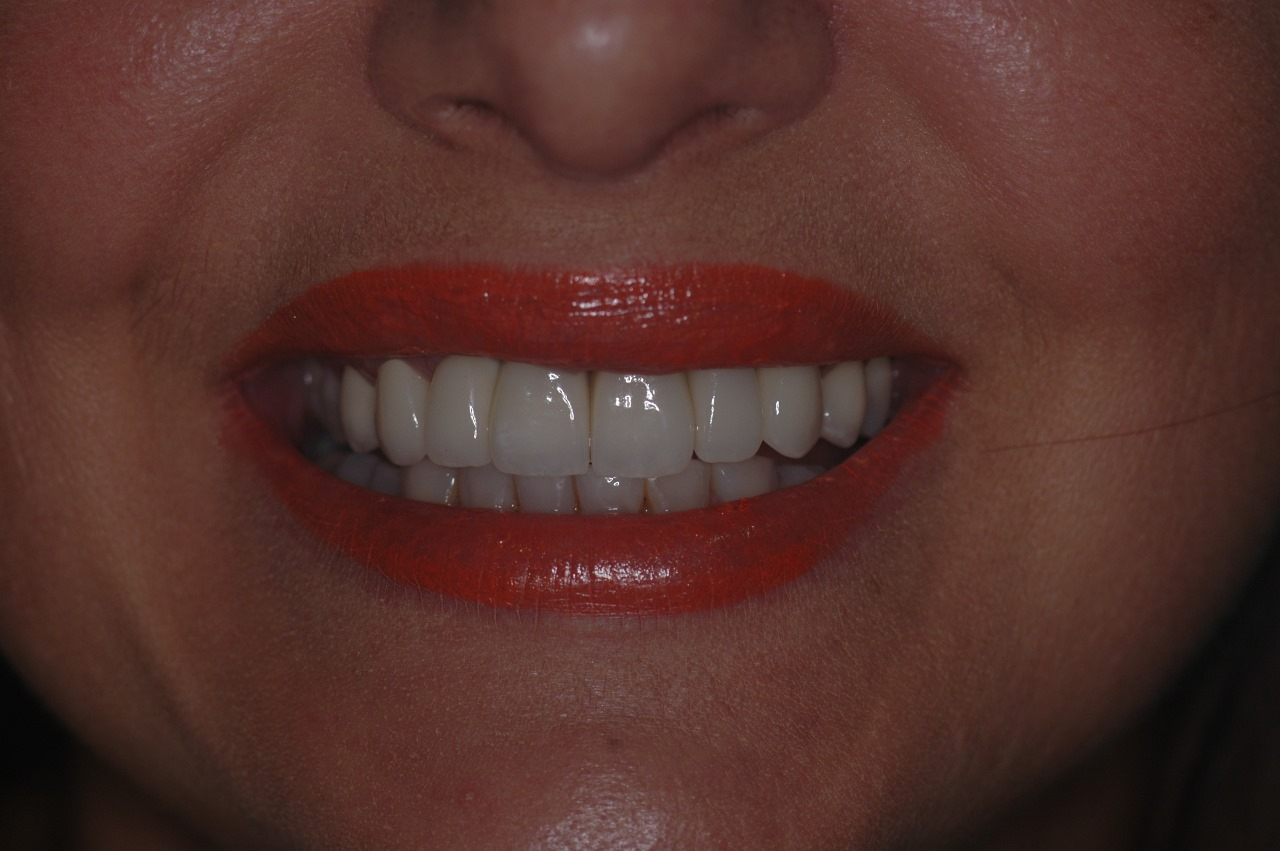 Depois do tratamento: Reabilitação Protética Sobre Implante