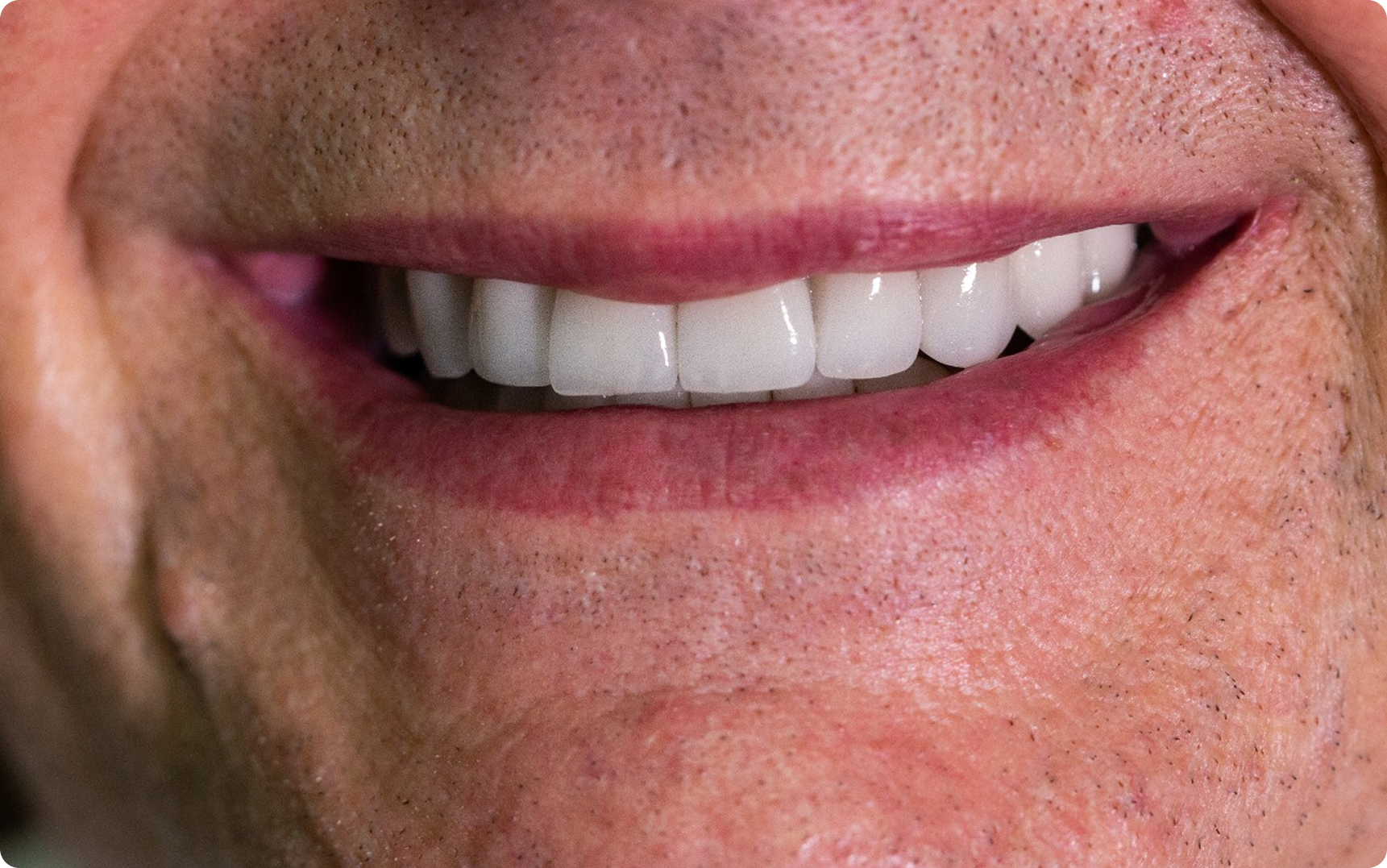 Depois do tratamento: Reabilitação Protética em Porcelana